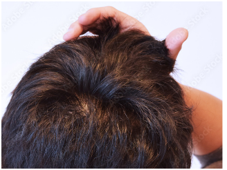 ツムジもバレない