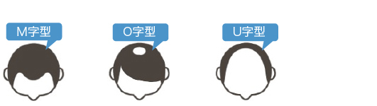 適応タイプは全てのAGA