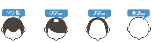 適応タイプは全てのAGAと脱毛症