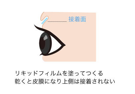 被膜折り込み式でメンズ二重瞼をつくる方法